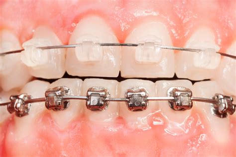 bracket metalicos y esteticos|champagne vs metal braces.